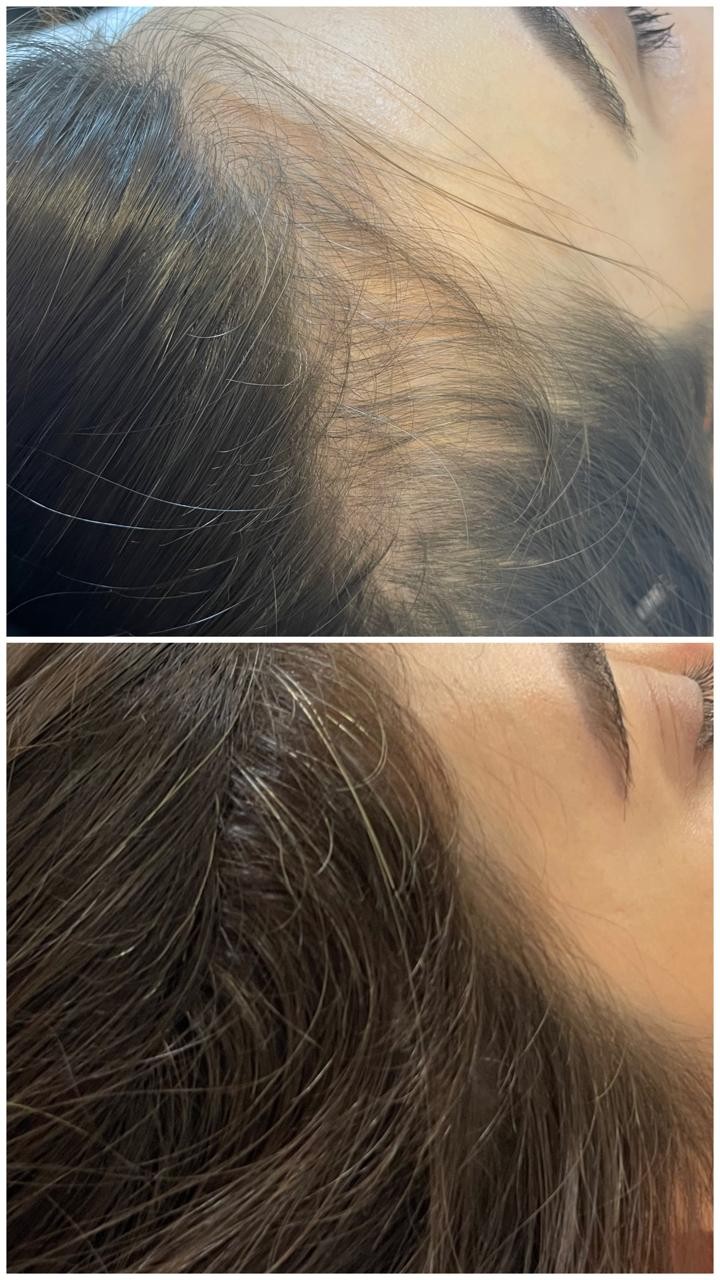 Antes e depois da densidade na linha frontal