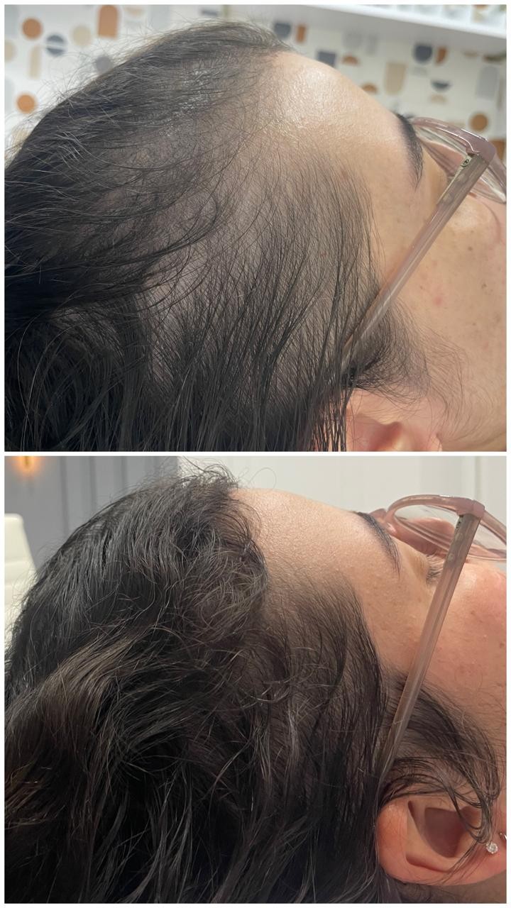 Antes e depois do acompanhamento da linha frontal