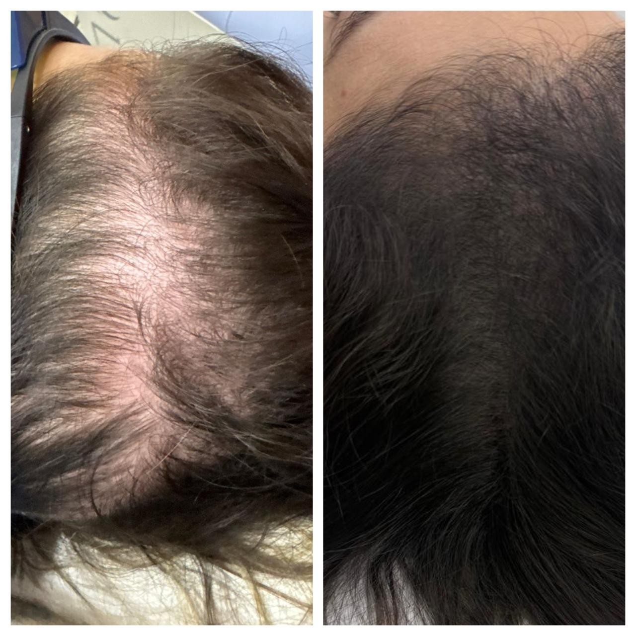 Antes e depois do acompanhamento capilar